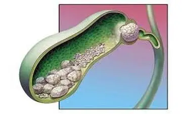 
نوشیدنی که از سنگ کیسه صفرا پیشگیری می‌کند
