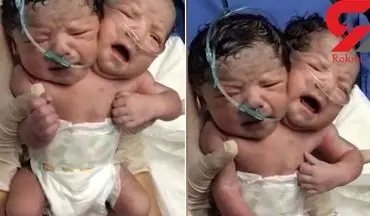 ویدئوی منتشر نشده از لحظه باور نکردنی تولد نوزاد دو سر+فیلم