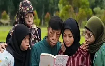 سندروم عجیبی که «خانواده مارمولکی» را اسیر کرد!