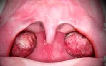 آیا می دانید لوزه ها چه کاری در بدن انجام می دهند؟