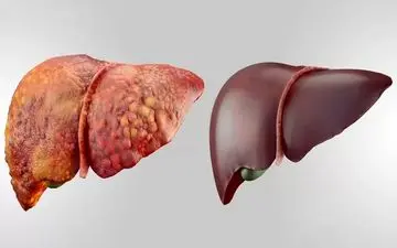 9 علامت هشدار دهنده برای تجمع سم در کبد