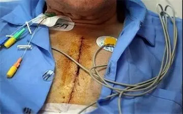 هرآنچه که باید درباره عمل قلب باز بدانید
