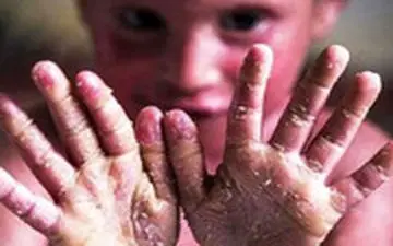 مرگ دردناک این کودک مظلوم دو ساله باعث عذرخواهی و دلجویی نماینده آمریکا در سازمان ملل از ایران شد