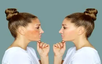 درمان لکه‌های تیره پوست