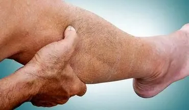 چه کسانی بیشتر در معرض گرفتگی عضلات پا هستند؟+درمان