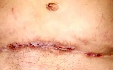 بخیه سزارین چرا عفونت می‌کند؟

