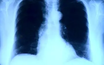 چند نشانه‌ هشداردهنده بیماری ریوی
