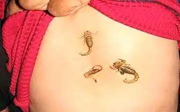 پدیده نادر پزشکی / کودک دهدشتی که بدنش عقرب تولید می کند ! + عکس 