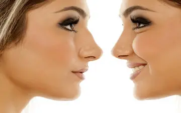  جراحی بینی به روش باز چیست؟ 