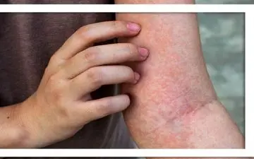 راهکاری برای گذران حساسیت بهاری