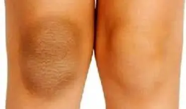 چگونه تیرگی زانو و آرنج را رفع کنیم؟+روش های خانگی