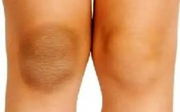 چگونه تیرگی زانو و آرنج را رفع کنیم؟+روش های خانگی