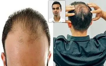 
پدر یا مادر؛ کدامیک مقصر طاسی فرزندان هستند؟