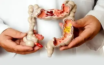 برای سندرم روده تحریک پذیر  دارو موثر است یا رژیم غذایی؟