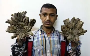 بیماری مرد درختی چیست؟

