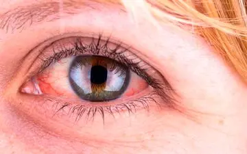  بیماری آرتریت پسوریاتیک پگونه باعث مشکلات چشمی می شود؟