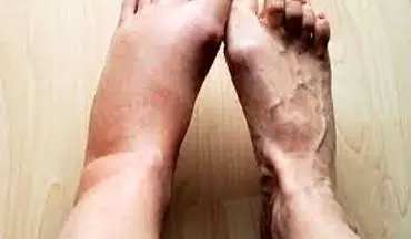 چند درمان خانگی موثر برای ورم پا‌ها
