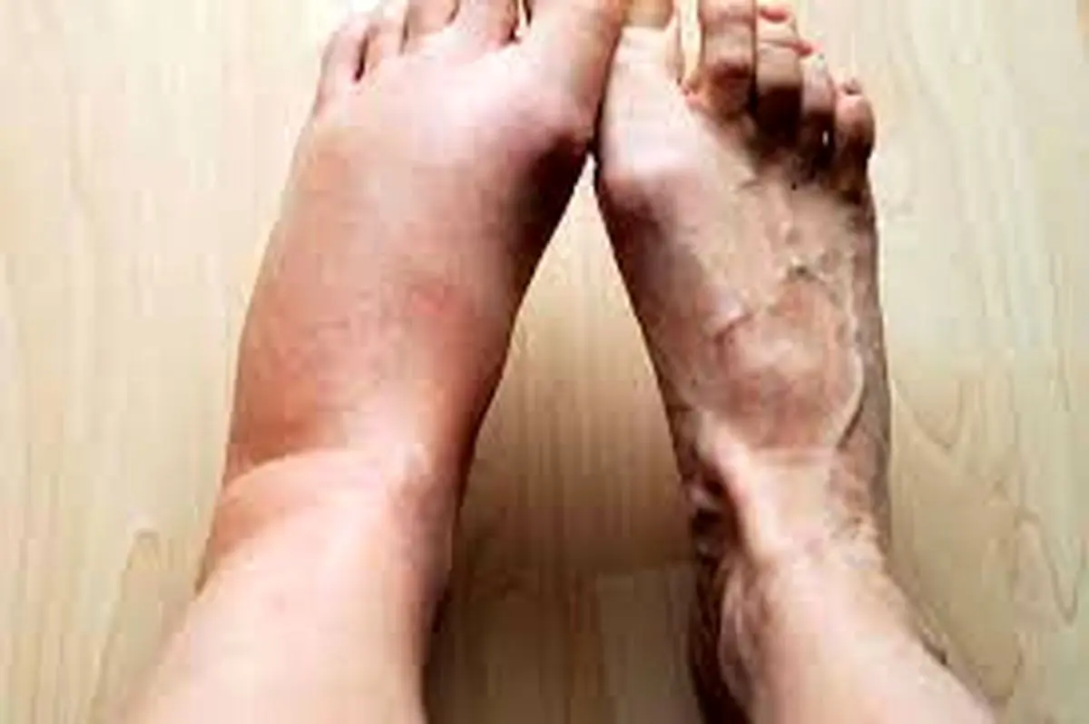 ورم پا |چند درمان خانگی موثر برای ورم پا‌ها