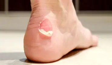 چطور از تاول، ترک پاشنه و پینه پا پیشگیری کنیم؟