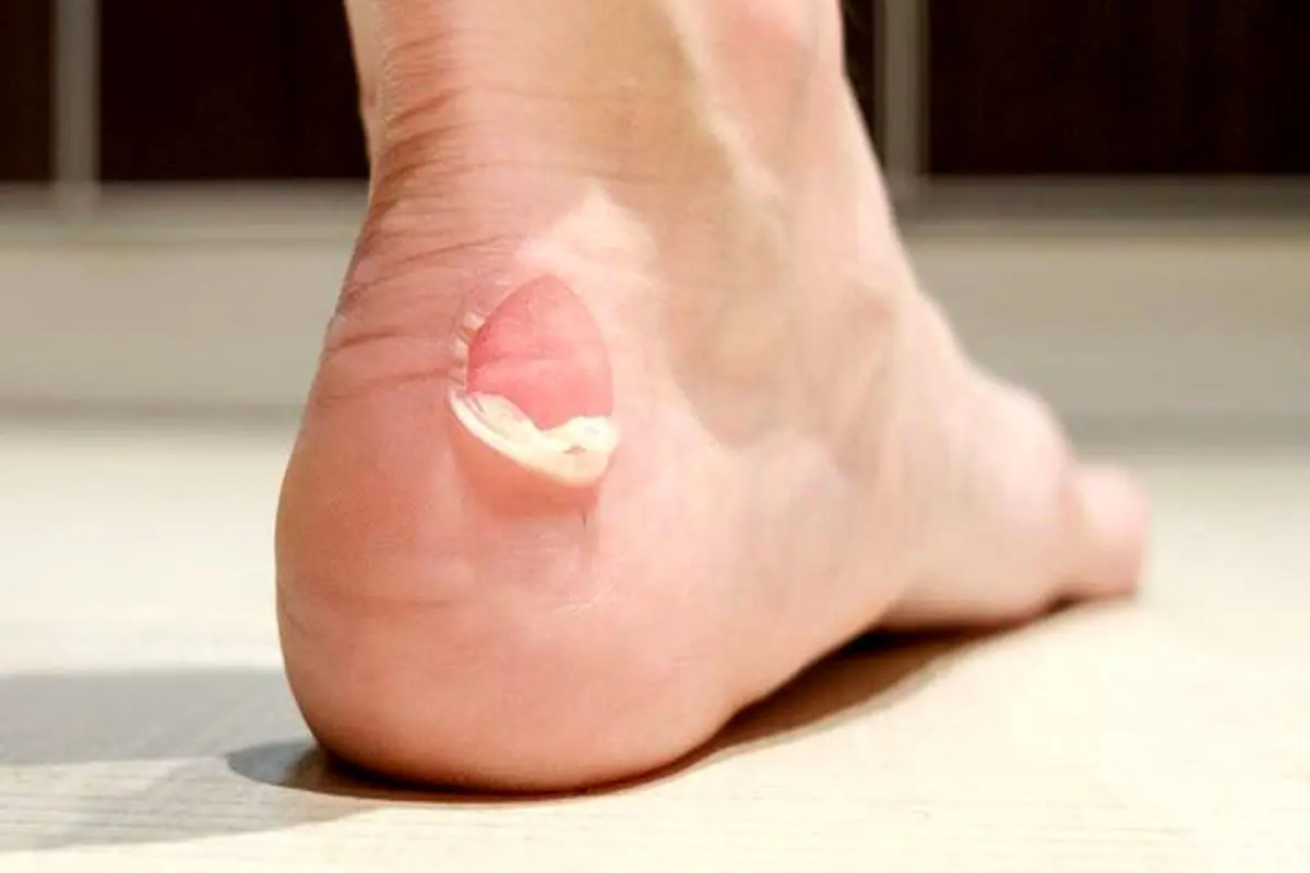 چطور از تاول، ترک پاشنه و پینه پا پیشگیری کنیم؟