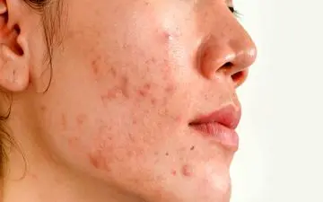 روش سریع و بی‌دردسر برای درمان جوشهای بزرگسالان