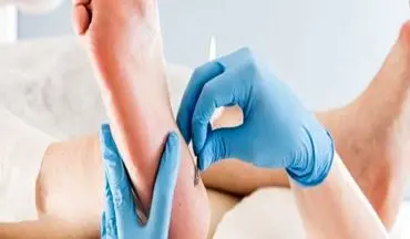 دیابتی ها بخوانند| درمان طخم پای دیابتی ها