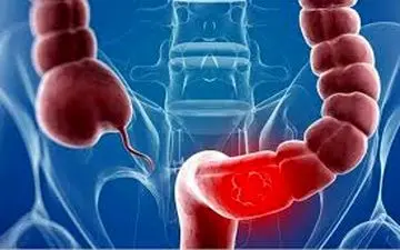 هشدار| این افراد مستعد سرطان روده بزرگ هستند!