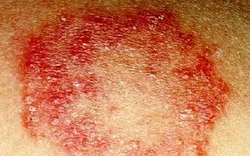 عفونت قارچی؛ نه از رابطه جنسی، بلکه از سبک زندگی!
