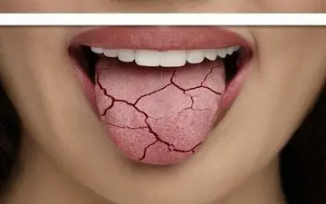 ۱۰ راه ساده برای خلاص شدن از خشکی دهان
