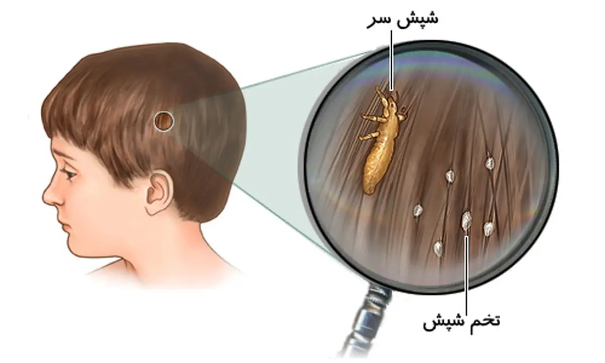 آیا زمستان باعث ابتلا به شپش در مدارس شده است؟! +نکات مهم 