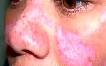 اختلال در بخش های مختلف بدن با بیماری لوپوس