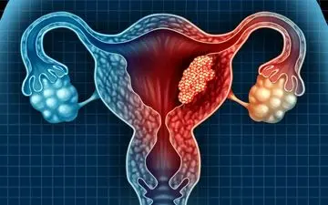 چاقی و سرطان رحم: ارتباط خطرناکی که باید بدانید! (با فیلم)