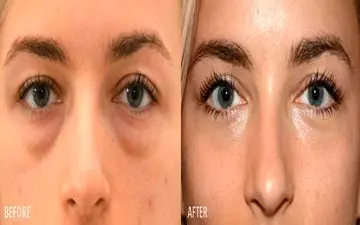 افتادگی پلک؛ تهدید خاموش برای بینایی در میانسالی و سالمندی