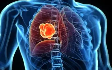 تشخیص زودهنگام سرطان ریه از طریق آزمایش خون ممکن شد