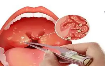 علائم سنگ لوزه/ چه زمانی به پزشک مراجعه کنیم؟