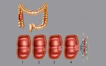 سرطان کولون چیست؟