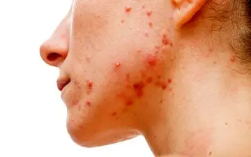 التهاب پوستی ناشی از استرس