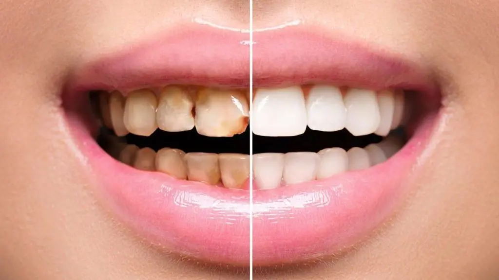 ونیز کامپوزیت چیست؟ آشنایی با بهترنی نوع و برند کامپوزیت دندان!