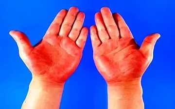 دلایل جدی التهاب کف دست