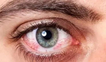 عوارض شنا کردن با لنزهای چشمی