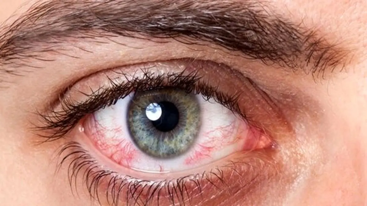 عوارض شنا کردن با لنزهای چشمی