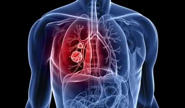 راهی که برای تشخیص زودهنگام سرطان ریه به شما کمک می کند
