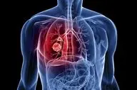 سرطان ریه؛ علل، پیشگیری، رژیم غذایی و زمان مراجعه به پزشک