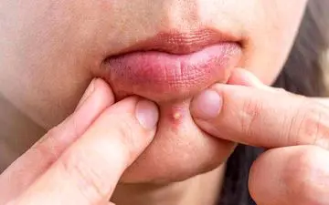 برای اینکه جوش نزنیم چه بخوریم؟