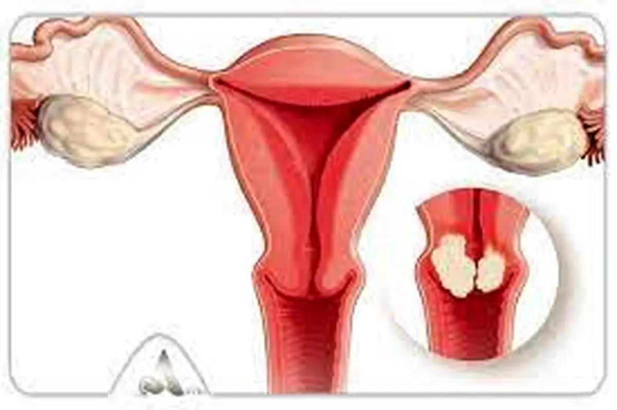  آیا ورم رحم بیماری خطرناکی است؟ | نحوه پیشگیری و درمان ورم رحم