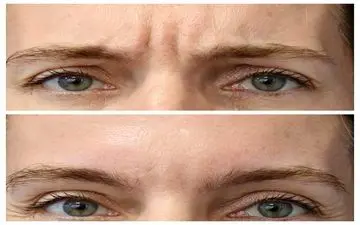 خط اخم دارید؟ نگران نباشید! با این روش های ساده و طبیعی خط اخم را از بین ببرید