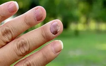 احتمال بروز قارچ در ناخن های کاشت شده