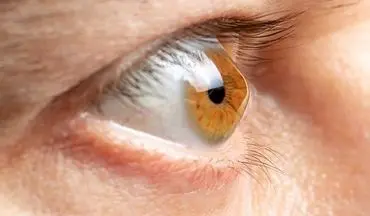 ۴ درصد ایرانی‌ها دچار این مشکل چشمی هستند