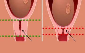 با انواع اختلالات در سرویکس بیشتر آشنا شوید