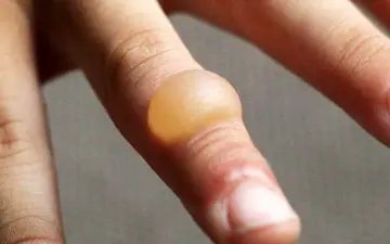 درمان صحیح سوختگی با روغن